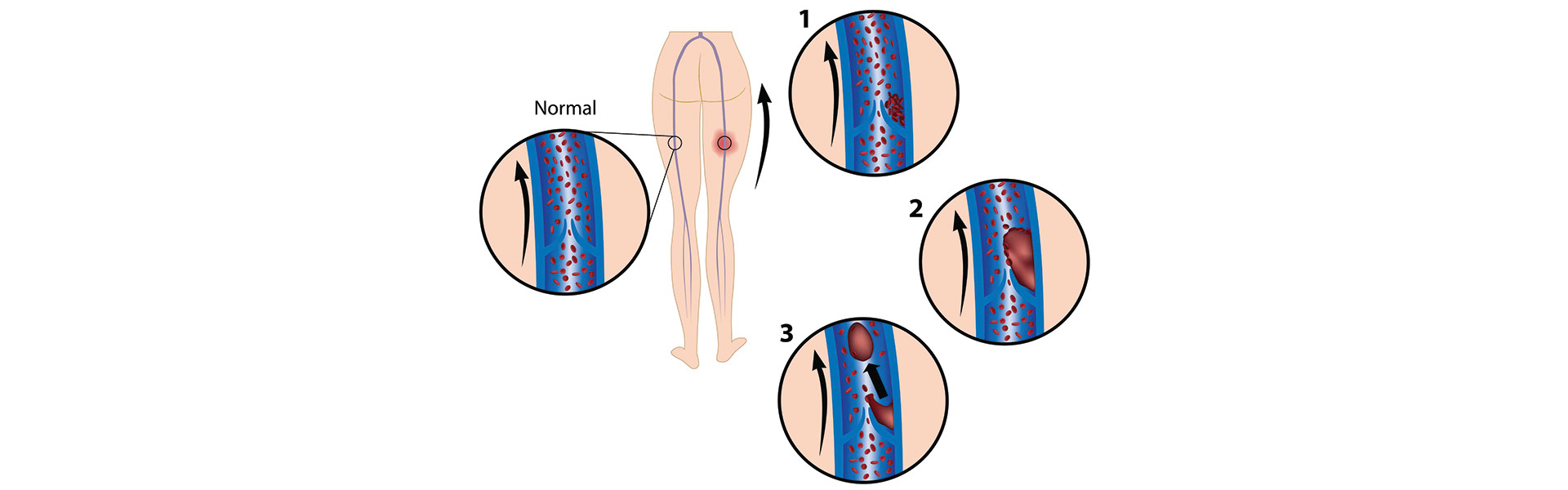 deep vein thrombosis (DVT) process