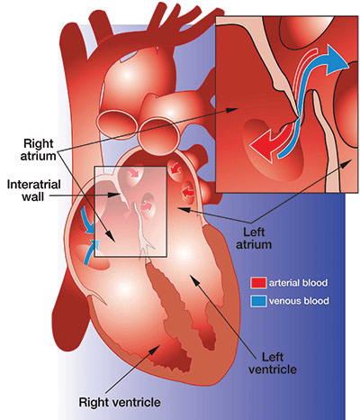 patent foramen ovale (PFO) diagram