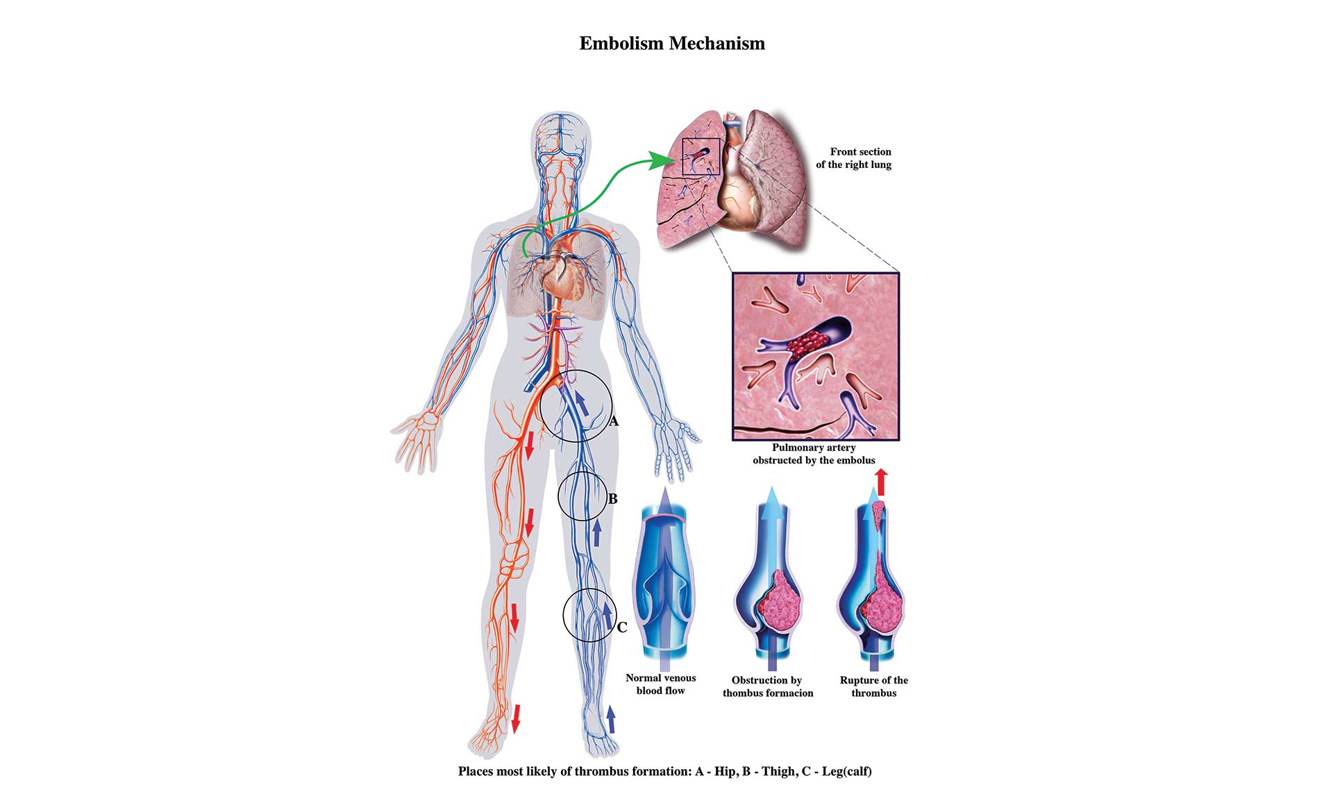 illustration of pulmonary embolism mechanism