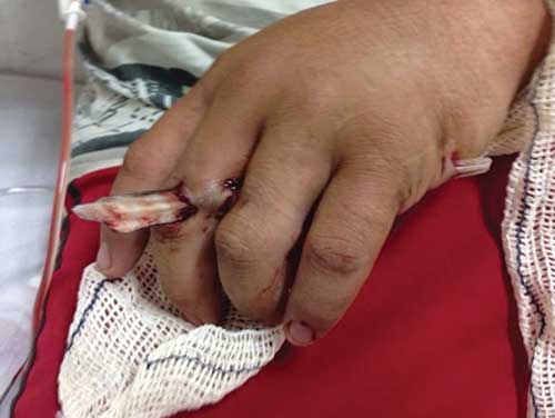 stingray barb punctures finger and hand